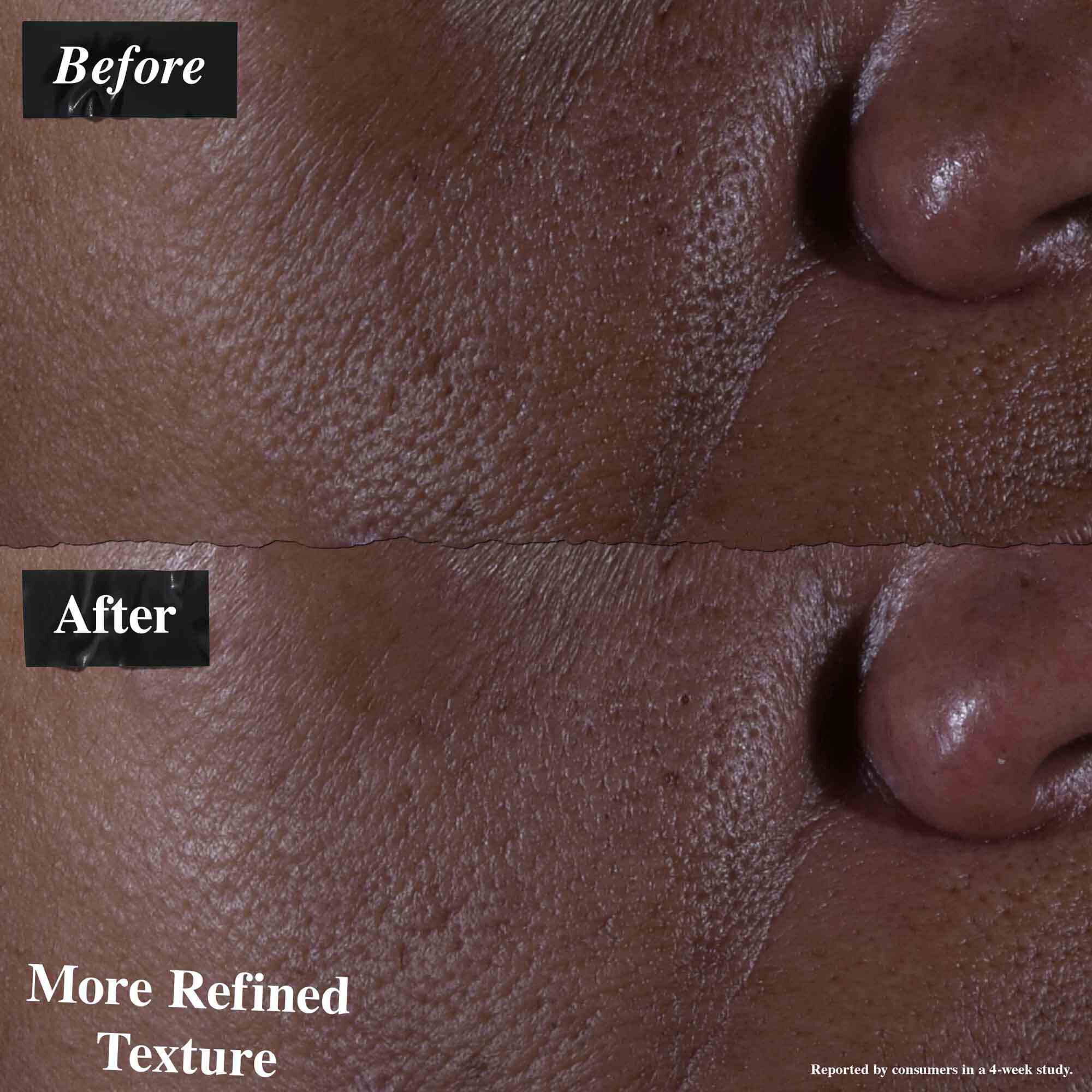 Сравнение преди и след, показващо кожа, третирана с Ultra Pure 9.8% Glycolic Acid Serum. Изображението „преди“ показва неравна текстура, докато изображението „след“ показва по-фина текстура.