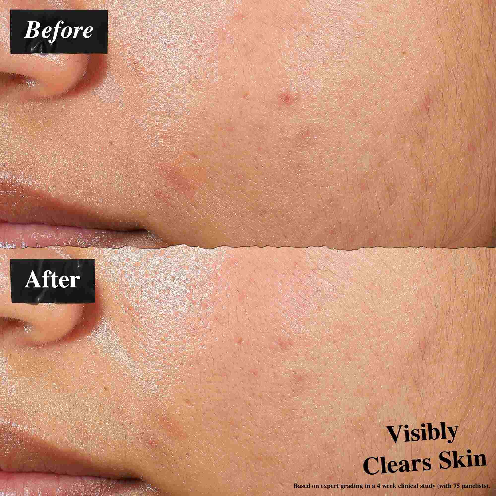 Сравнение преди и след, показващо кожа, третирана с Expertly Clear Blemish-Treating & Preventing Lotion. Изображението „преди“ показва несъвършенства и неравна текстура на кожата, докато изображението „след“ показва видимо по-чиста кожа.