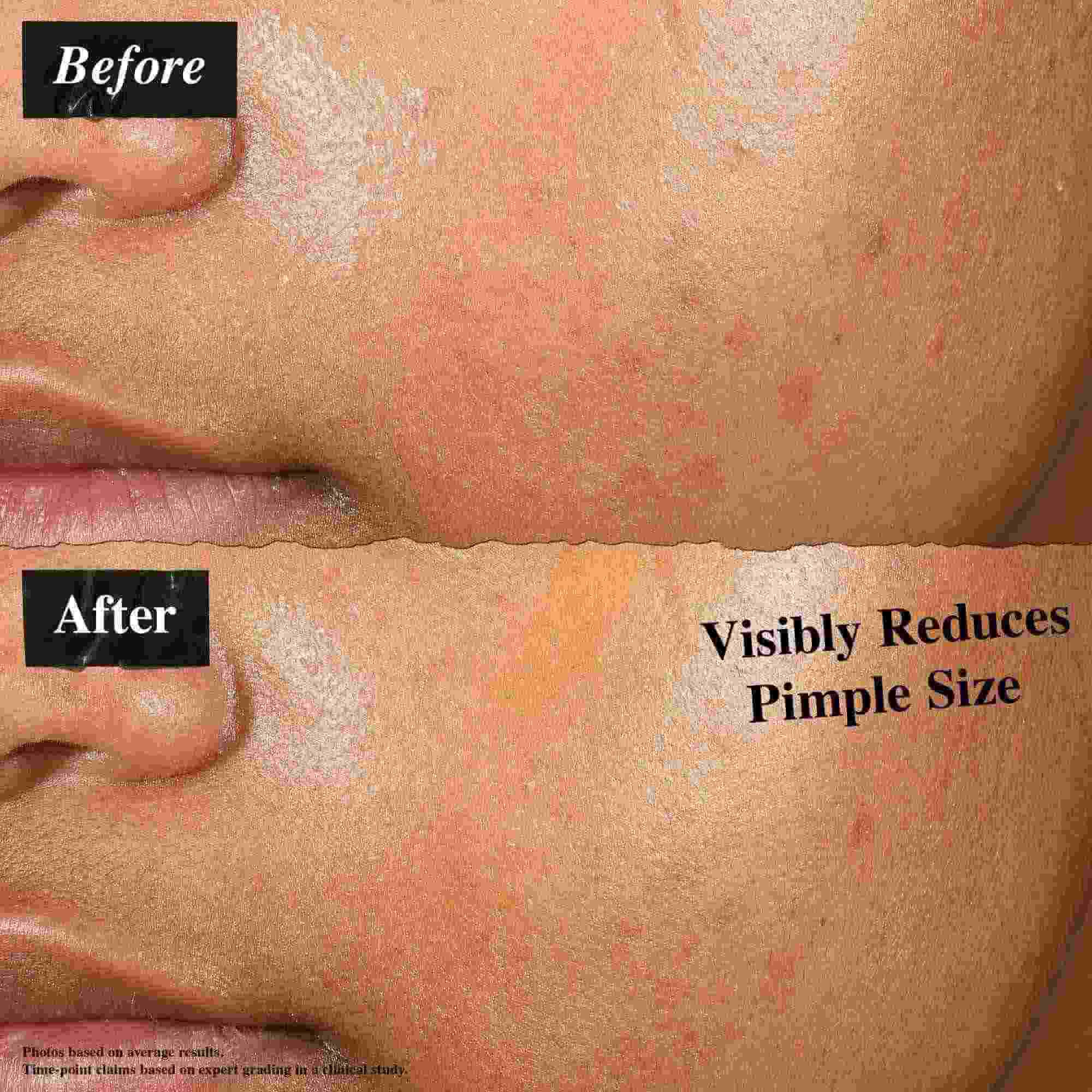 Сравнение преди и след, показващо кожа, третирана с Truly-Targeted Blemish-Clearing Solution. Изображението "преди" показва видими пъпки, докато изображението "след" показва намален размер на пъпките.