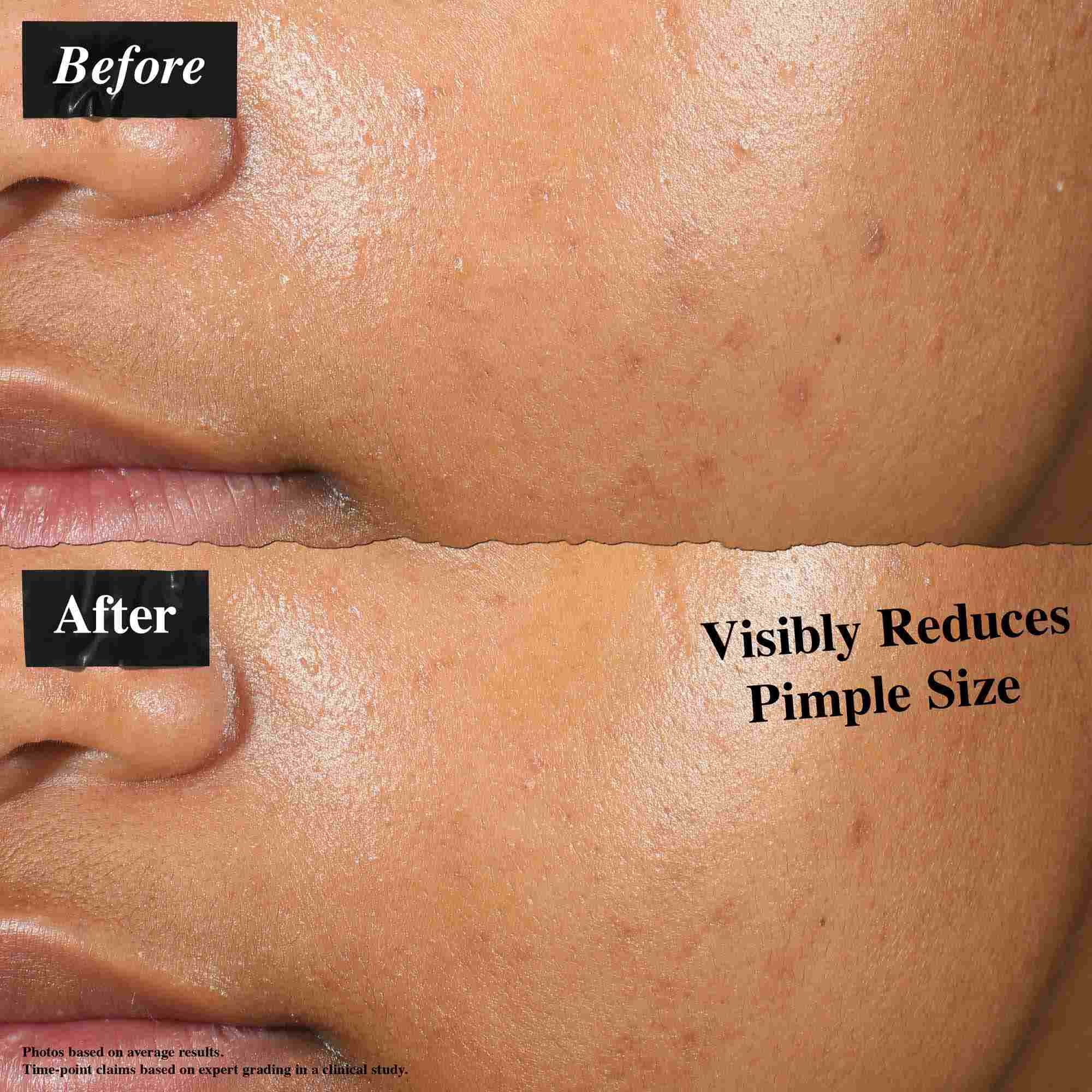 Сравнение преди и след, показващо кожа, третирана с Truly-Targeted Blemish-Clearing Solution. Изображението "преди" показва видими пъпки, докато изображението "след" показва намален размер на пъпките.