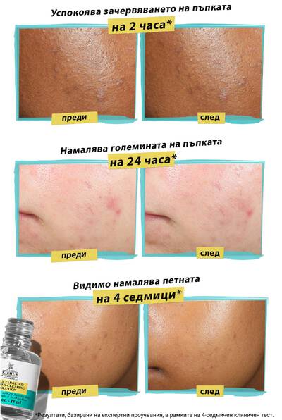 Alt text: A comparison image showing the effects of a skincare product on acne. The top two panels show before and after results of reduced pimple color in 2 hours, with noticeable color improvement. The middle panels depict before and after results of reduced pimple size in 24 hours, showing smaller pimples after treatment. The bottom panels illustrate before