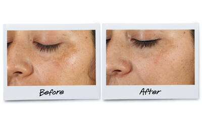 Before and after images of a woman's face, focusing on her skin texture and appearance around the eyes. The "Before" image shows uneven skin tone and some blemishes, while the "After" image displays smoother, clearer skin.