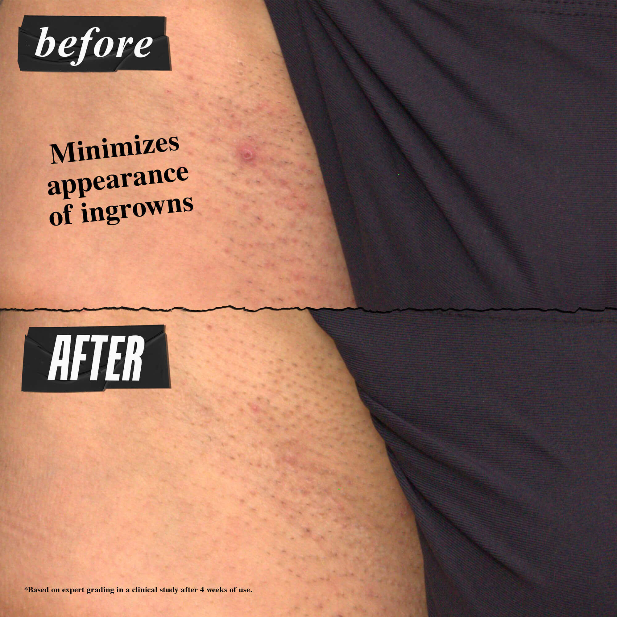 Before and After Ingrown Hair and Tone-Correcting Intimate Drops