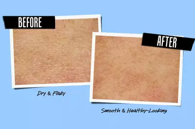 Before and after images of skin, with the left side labeled "Before" showing dry and flaky skin and the right side labeled "After" displaying smooth and healthy-looking skin.