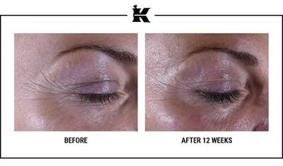 Alt text: "Side-by-side comparison of a person's eye area showing visible skin improvement after 12 weeks of treatment, with reduced wrinkles and smoother texture."