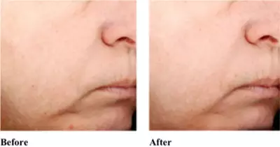 Alt text: "Comparison of a person's profile view of their chin and cheek area, labeled 'Before' on the left and 'After' on the right, showing visible changes in skin texture and firmness."